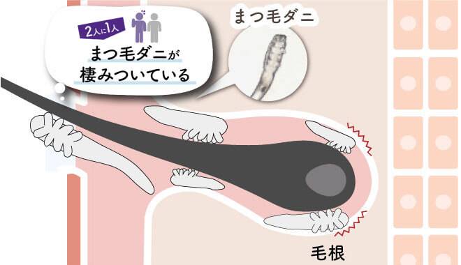 実は2人に1人、まつ毛ダニがまつ毛に棲みついてます!まつ毛の周りにまつ毛ダニが棲みついている様子