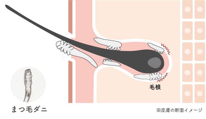 まつ毛の毛根にまつ毛ダニが住みついている様子